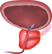 Prostata ingrossata o infiammata